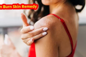 Sun Burn Skin Remedy